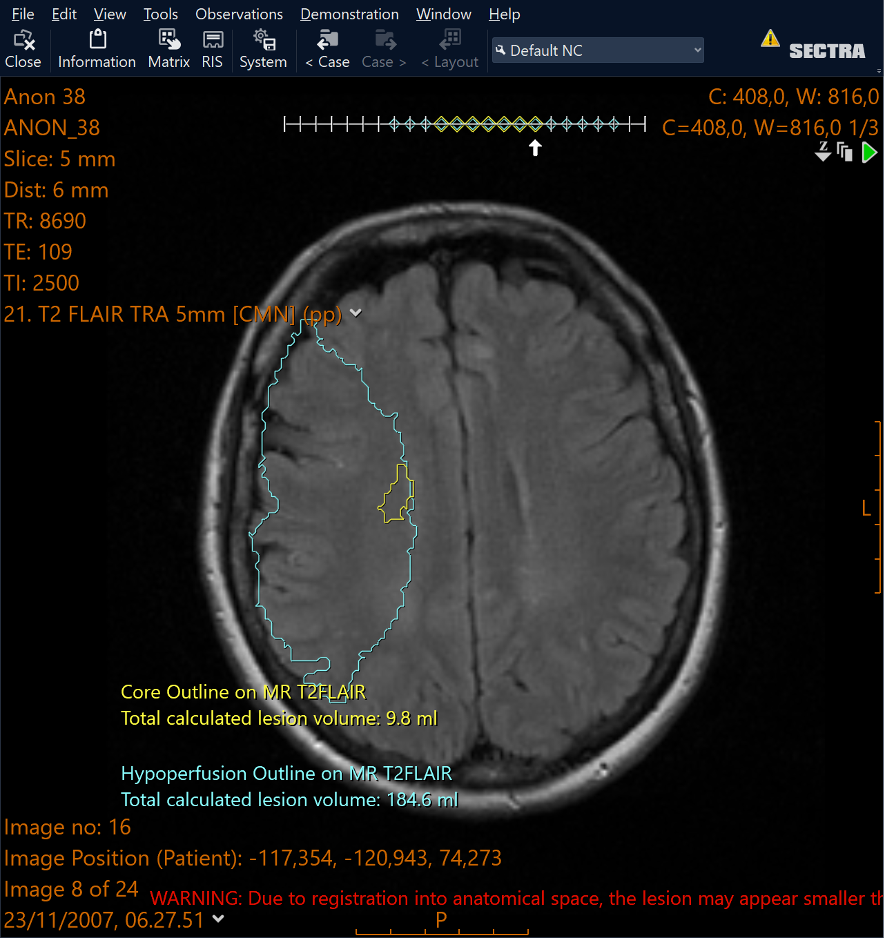 Cercare Stroke Sectra Amplifier Marketplace