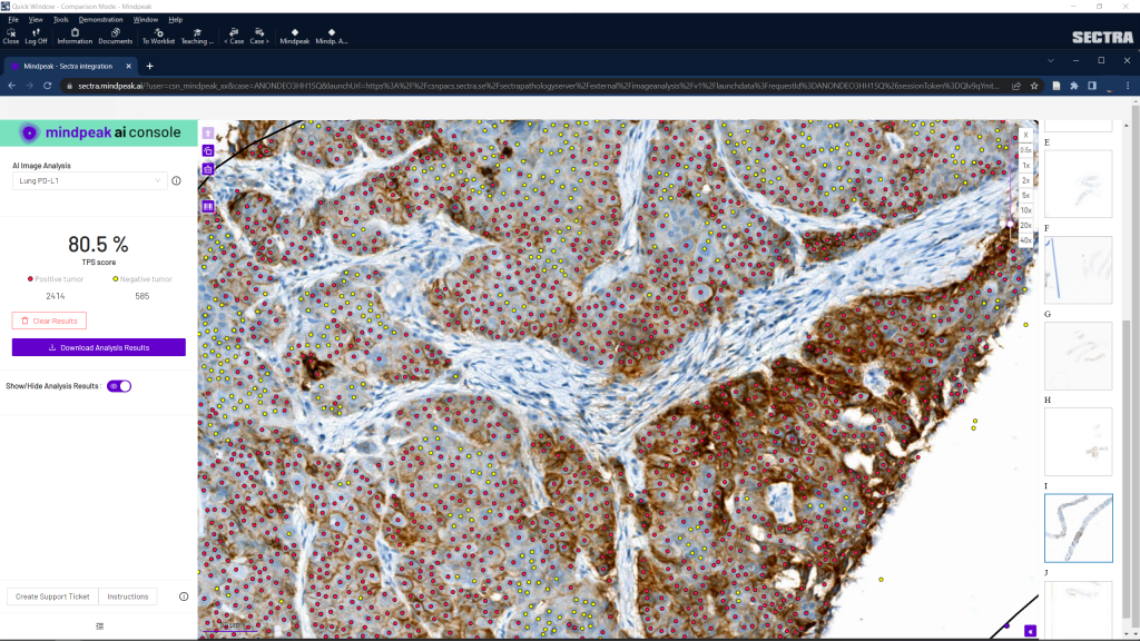 Mindpeak Lung (NSCLC) PD-L1 (SP263) RoI - Sectra Amplifier Marketplace