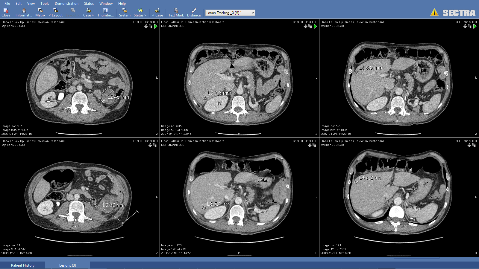 Screenshot from Sectra Lesion Tracking application