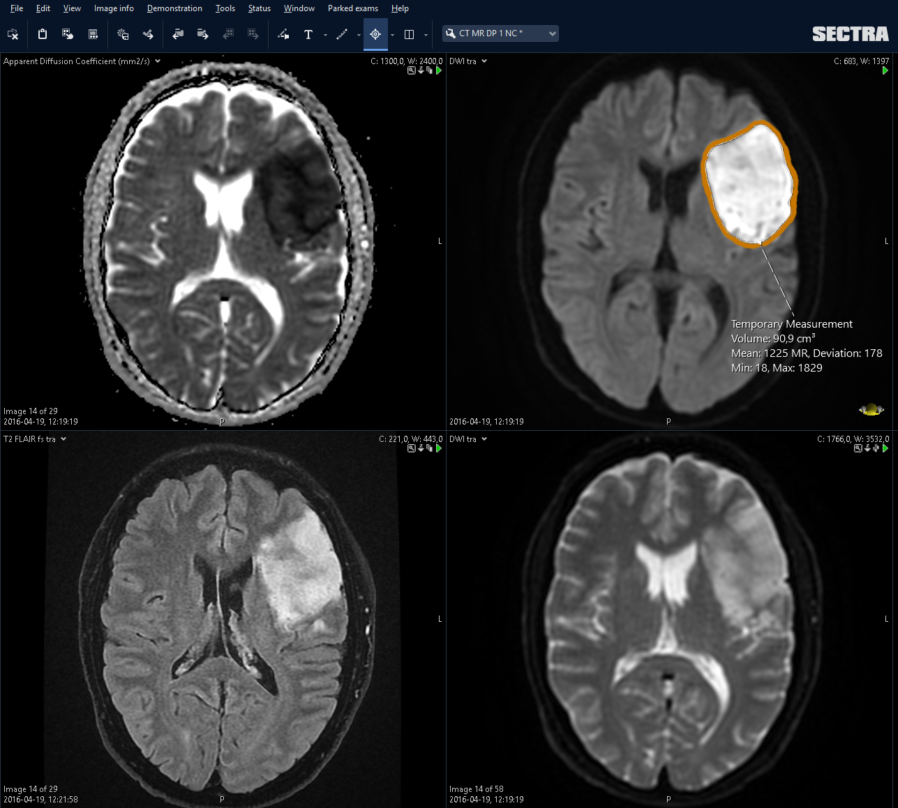 Automatic volume segmentation using Sectra's Volume Measurement tool