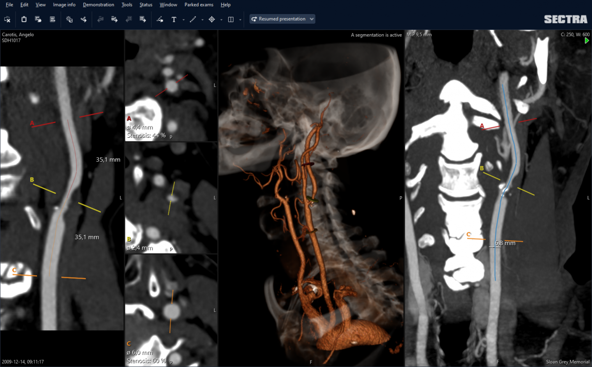 A screenshot of the Sectra Vessel Analysis tool